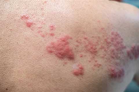 Shingles could be new but rare side effect of Covid vaccine, docs discover