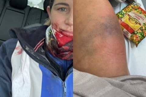 Jockey Michelle Payne reveals shocking injuries including leg ‘twice its size’ after being kicked..