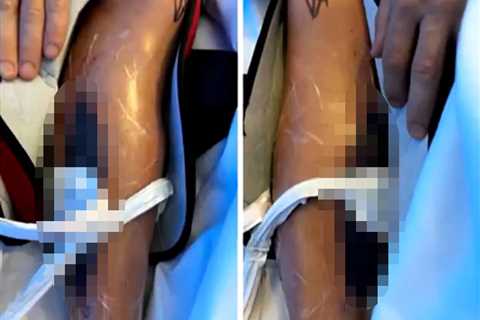 Jockey reveals gruesome surgery images after leg ‘exploded’, leaving him in so much pain he begged..