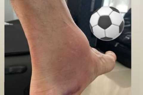 Angel Di Maria played on in Copa America final with horror swollen ankle after suffering injury in..