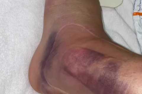 Ex-Arsenal star Dani Ceballos shares horror picture of ankle after nasty injury for Spain at Tokyo..