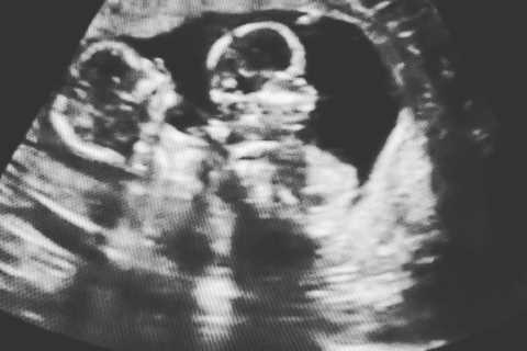 Teen Mom Catelynn Lowell pregnant with TWINS one year after she suffered miscarriage with husband..