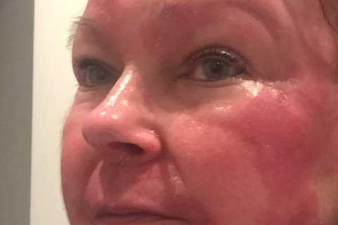 My mum died covered in deep, agonising wounds after docs mistook cancer for eczema and the menopause