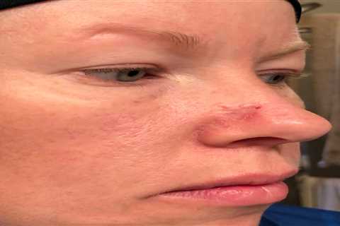 I couldn’t look at myself after acne scar turned cancerous and left gaping hole in my nose