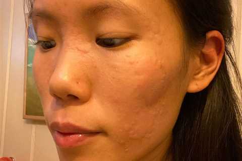 Pics reveal how woman broke out in ‘super itchy’ hives over her face and body after being struck..