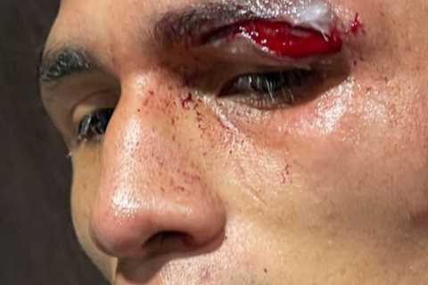 Eddie Hearn shares gruesome snap of Mauricio Lara’s horror eye cut that saw his rematch with Josh..