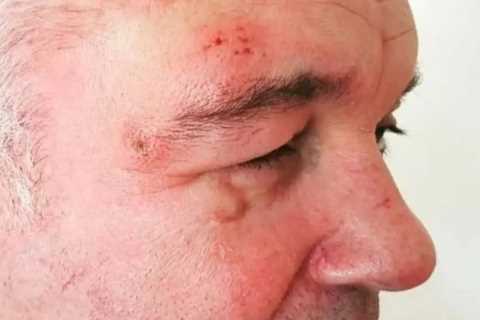 This Morning’s Eamonn Holmes left looking unrecognisable after horrifying shingles battle