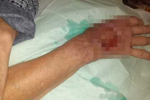 Gran left with gaping wound on hand after ‘botched’ hospital injection led to massive blister
