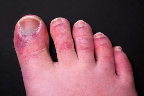 What is Covid toes? What are the symptoms?