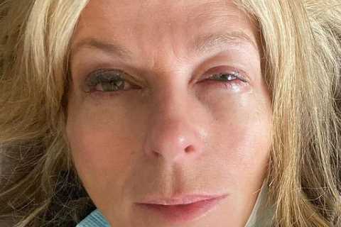 Kate Garraway reveals painful-looking swollen eyes after horror ‘contact lens’ injury during recent ..