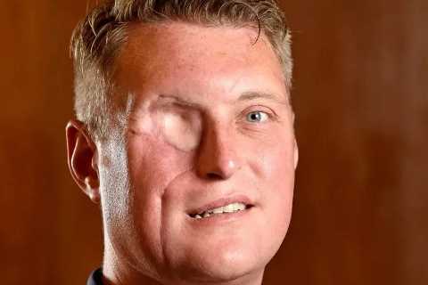 I was left with a huge hole where my eye should be after my only cancer symptom was a watering eye
