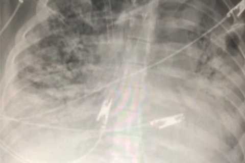 Shocking X-rays reveal the huge difference Covid vaccines really make