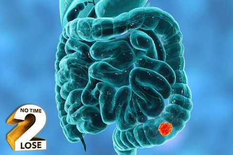 Bowel cancer symptoms: What are the early symptoms and when should I start to worry?