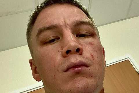 Boxer Viktor Kotochigov shows off horror burns from ‘ACID attack after gang of men break into UK..