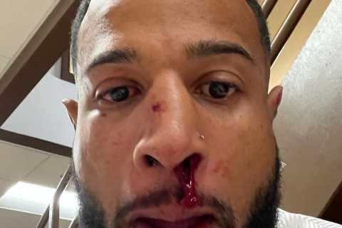 The Challenge’s Nelson Thomas suffers broken nose after he was punched in the face over his..