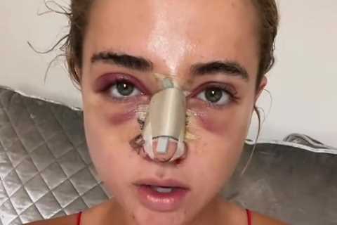 Love Island’s Georgia Harrison reveals bruised and battered face after secret nose job