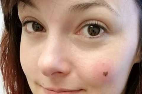 I loved the heart-shaped freckle on my face – until doctors told me it could kill me