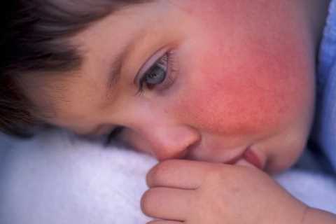 I’m a doctor and here’s an unusual Omicron symptom to watch out for in kids