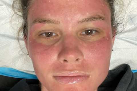 RHOC’s Meghan King shares shocking photos after microneedling procedure following split from..