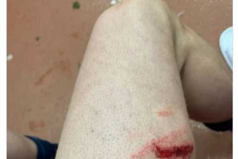 Manchester City star Aymeric Laporte shows off horror gash on thigh after being caught by Stuart..