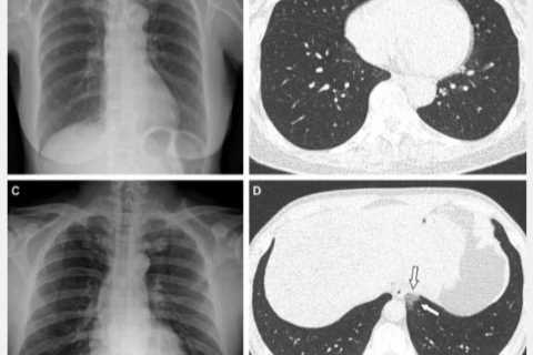 Shocking scans reveal just how important it is to get your Covid vaccines
