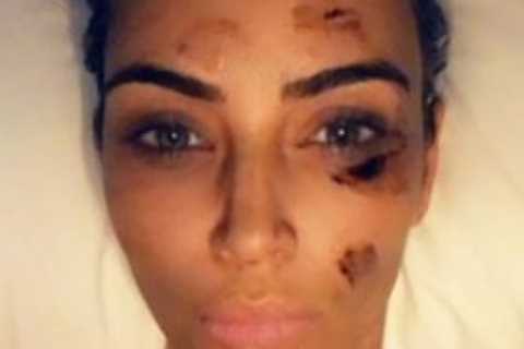 Kim Kardashian gives fans intimate look at doctor’s visit to treat her dyschromia skin disorder..