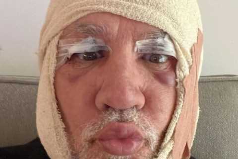 Celebs Go Dating’s Wayne Lineker reveals his two black eyes and bruised face after secret surgery