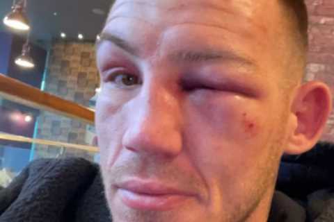Liam Williams shows off brutal eye injury and battered face after Chris Eubank Jr beating including ..