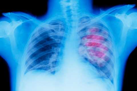 I’m a doctor and these 5 changes could be a sign of deadly lung cancer