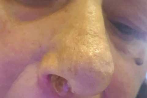 My grandson can’t look at me after ‘wart’ engulfed my nose – and now I need half my face removed