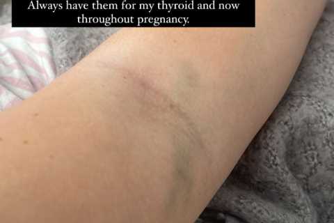 Pregnant Olivia Bowen shows off painful looking bruises on her arm as she reveals health condition