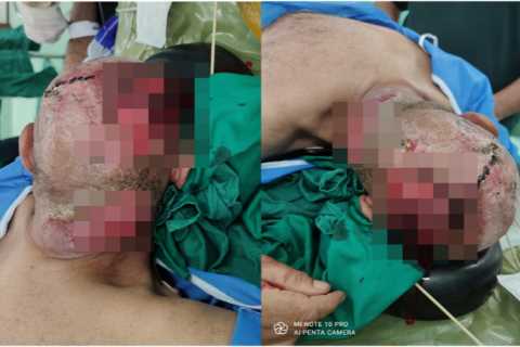 Shocking pictures show man’s scalp ravaged by cancer sparked by common virus