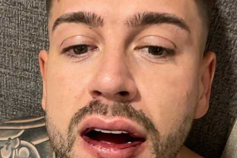 My jaw’s broken in 3 places after brutal attack and nerves are damaged – I can’t feel my face, says ..