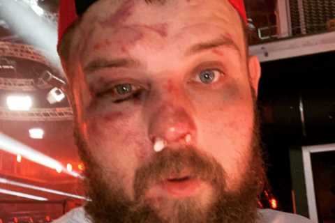 Face-slapping king Vasily Kamotsky shows off horror injuries after he is beaten up in bare-knuckle..