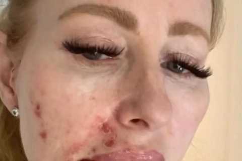 I thought I had eczema on my face but the truth was much worse – I look like an acid attack victim