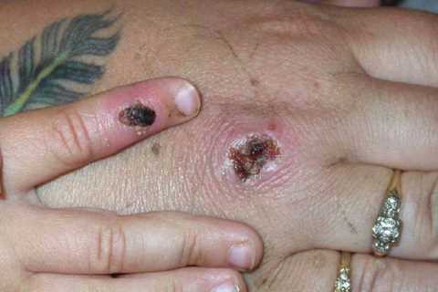 Ignore the hoohah, monkeypox virus isn’t the new Covid