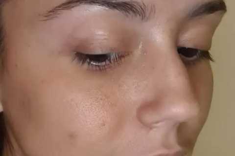 Love Island star reveals new nose after breaking bones in horror car crash