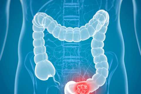 Bowel cancer DNA test to spare thousands pointless chemotherapy