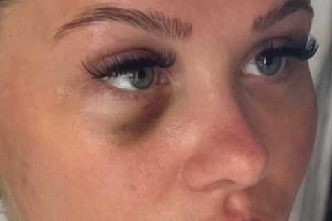 Love Island’s Shaughna shares shocking picture of herself with a black eye