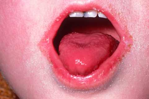 Urgent warning to parents as cases rise of dangerous Victorian disease