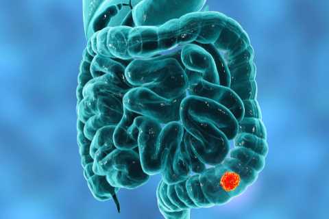Thousands of bowel cancer deaths could be avoided if NHS made simple change