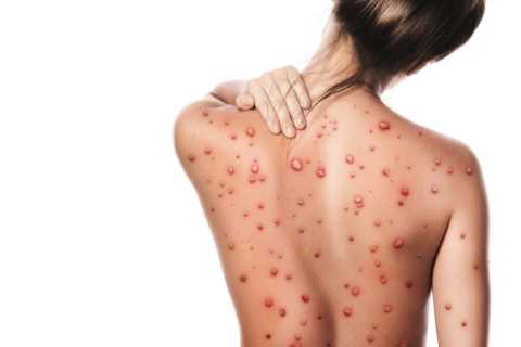 Vital first steps to take after monkeypox infection &amp; top sign you have the virus revealed by..