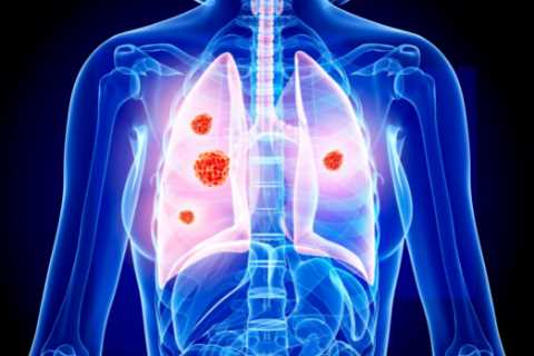 How to spot when your cough could be an early warning sign of the UK’s deadliest cancer