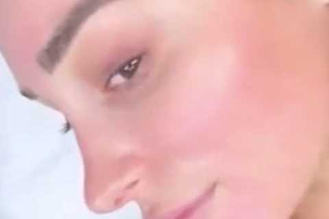 Love Island’s Coco Lodge reveals red sore face after undergoing chemical peel to get rid of acne..