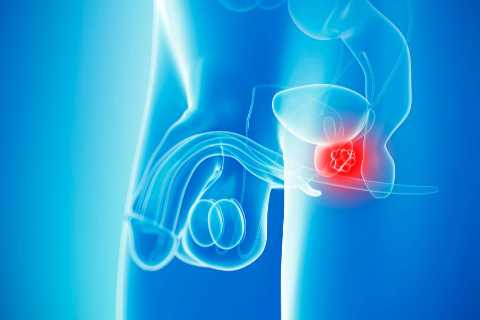 Brits could ‘safely avoid invasive prostate cancer checks by looking at genetic risk’