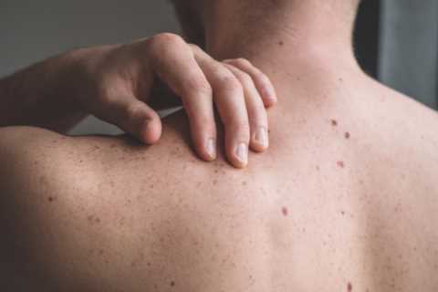 Skin cancer: What are the signs and symptoms – and what does it look like?