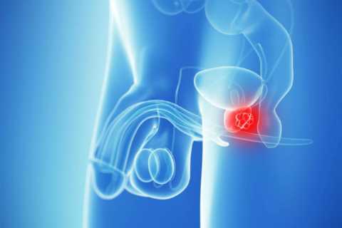 What is prostate cancer? Signs and symptoms of the condition