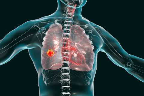 The 12 ways to spot cancer – according to the NHS