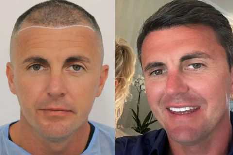Billie Faiers’ husband Greg Shepherd shows off results of hair transplant in before and after pics