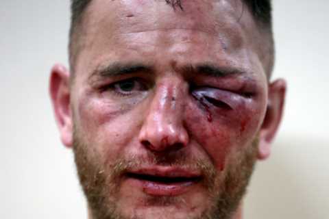 Bare-knuckle boxer Nathan Decastro looks unrecognisable after taking brutal beating as he shows off ..